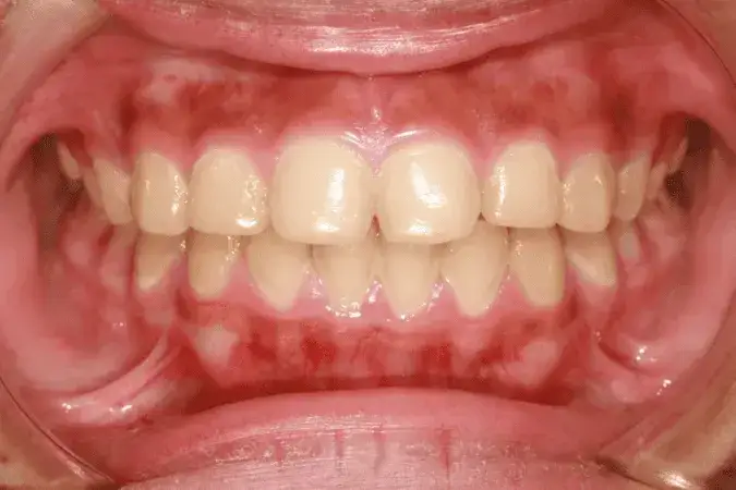 Jak wyglądają zdrowe dziąsła? Oto cechy, które musisz znać