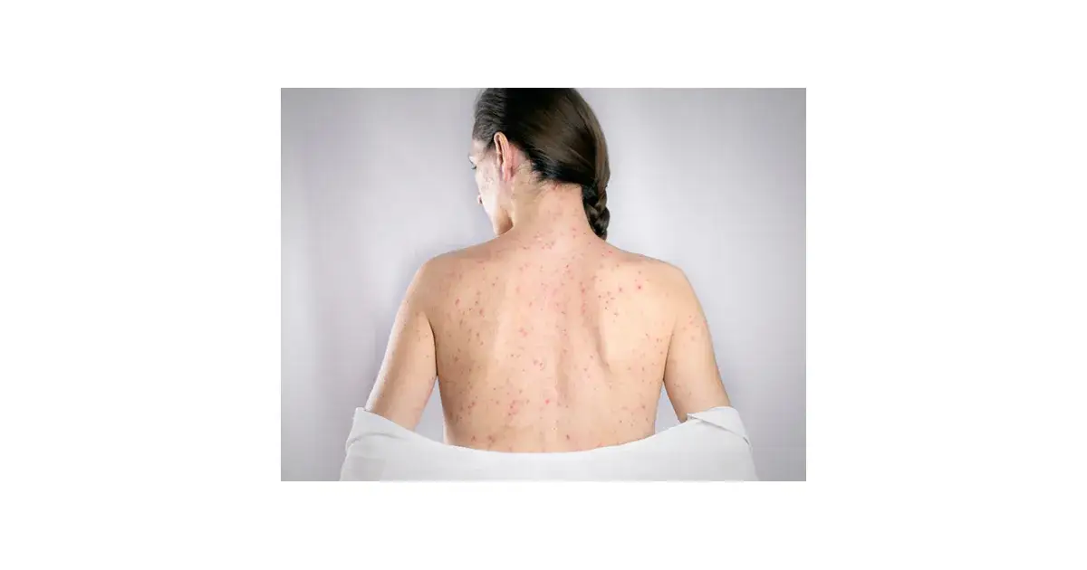 Różyczka w ciąży: objawy, zagrożenia i kluczowe informacje