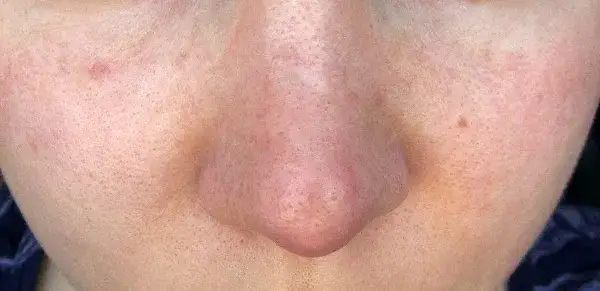 Jak wygląda zapchana cera? Objawy i cechy, które musisz znać