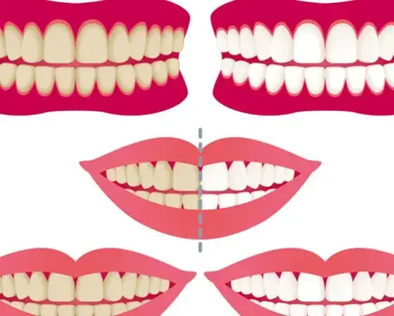 Jak bezpiecznie wybielić zęby i uniknąć uszkodzenia szkliwa