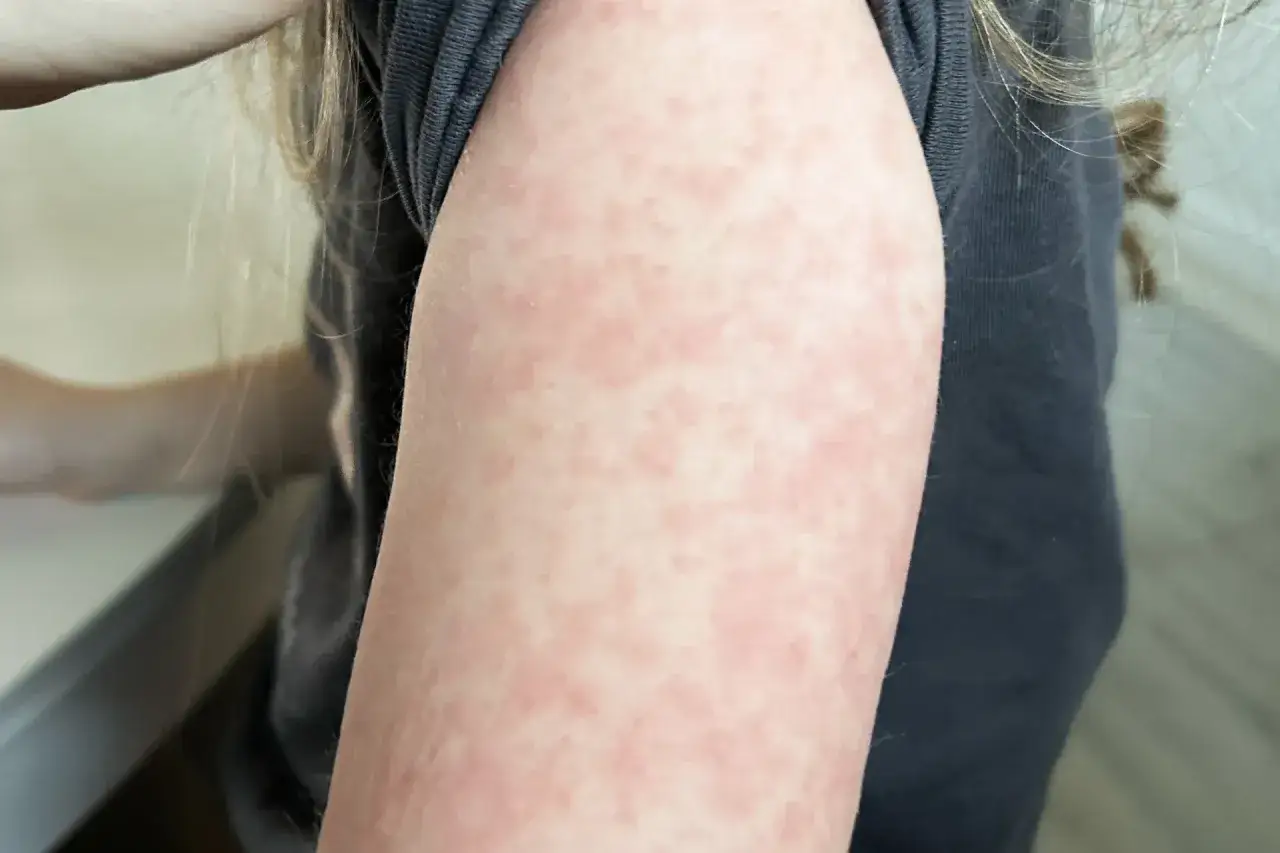 Rumień zakaźny kiedy do przedszkola: ważne informacje o zakaźności i powrocie