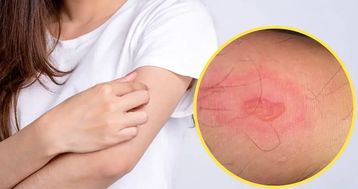 Ugryzienie pająka co robić: skuteczne sposoby na złagodzenie objawów