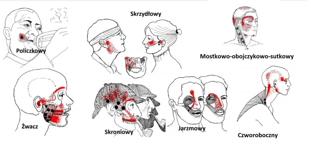 Ilustracje pokazują punkty bólu związane ze stawem skroniowo-żuchwowym. Różne obszary głowy i szyi zaznaczone czerwonymi kropkami wskazują potencjalne źródła bólu.