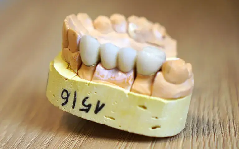Koszt mostu protetycznego na 1 ząb: Dlaczego to 3 punkty? Ceny