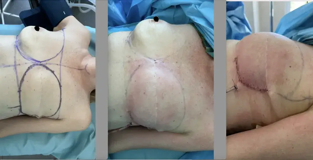 Lumpektomia: Zobacz, jak naprawdę wygląda pierś i blizna po operacji.