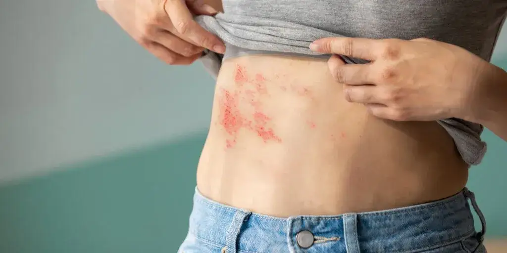 Nerwica skóry objawy: Jak rozpoznać i zrozumieć problemy skórne