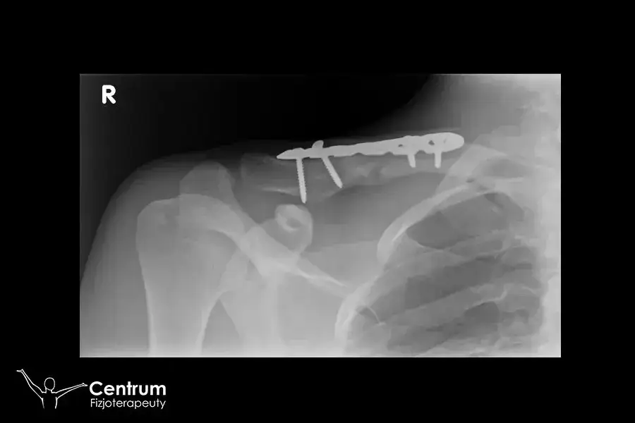 Ile trwa rehabilitacja po złamaniu obojczyka? Kluczowe informacje o czasie regeneracji