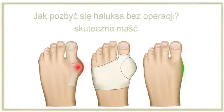 Apteczne sposoby na haluksy: Co naprawdę działa bez recepty?