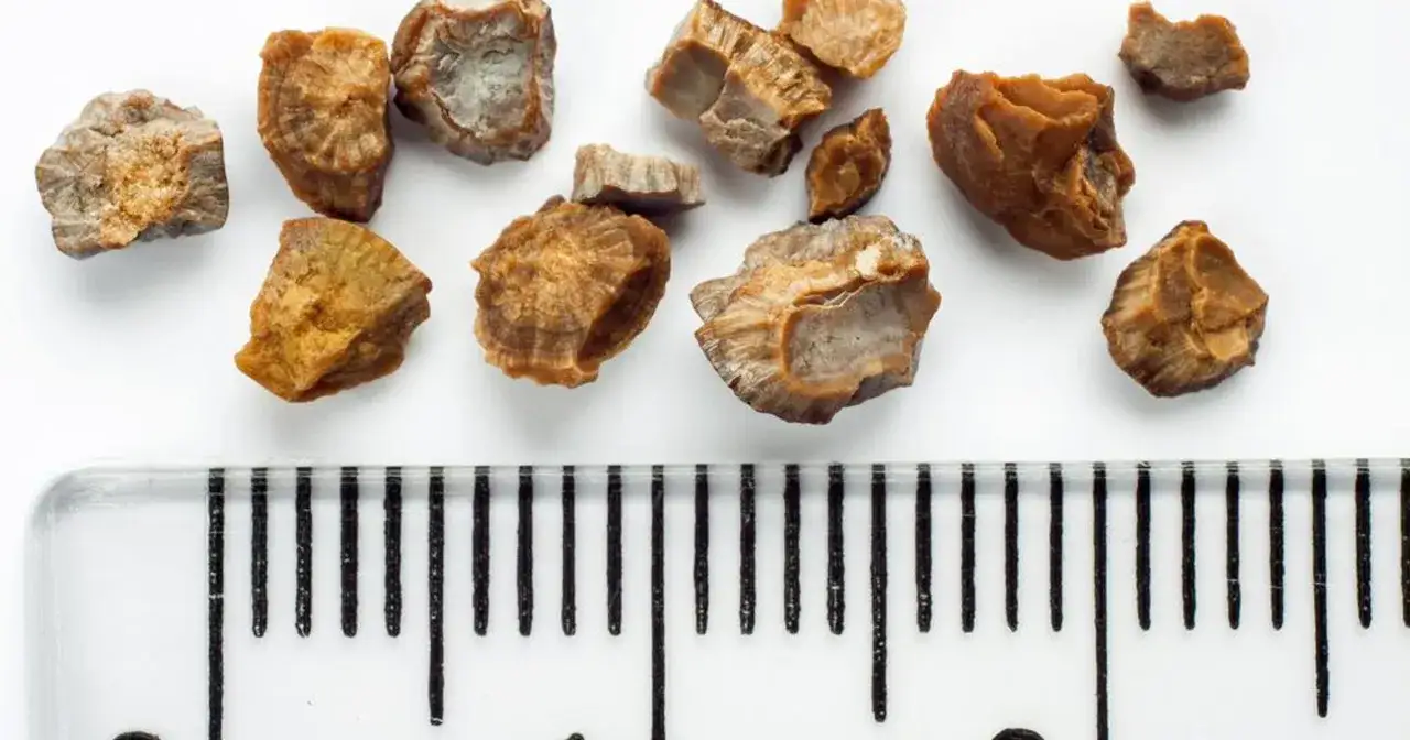 Kamica nerkowa a kakao: Jak jeść czekoladę bez ryzyka?