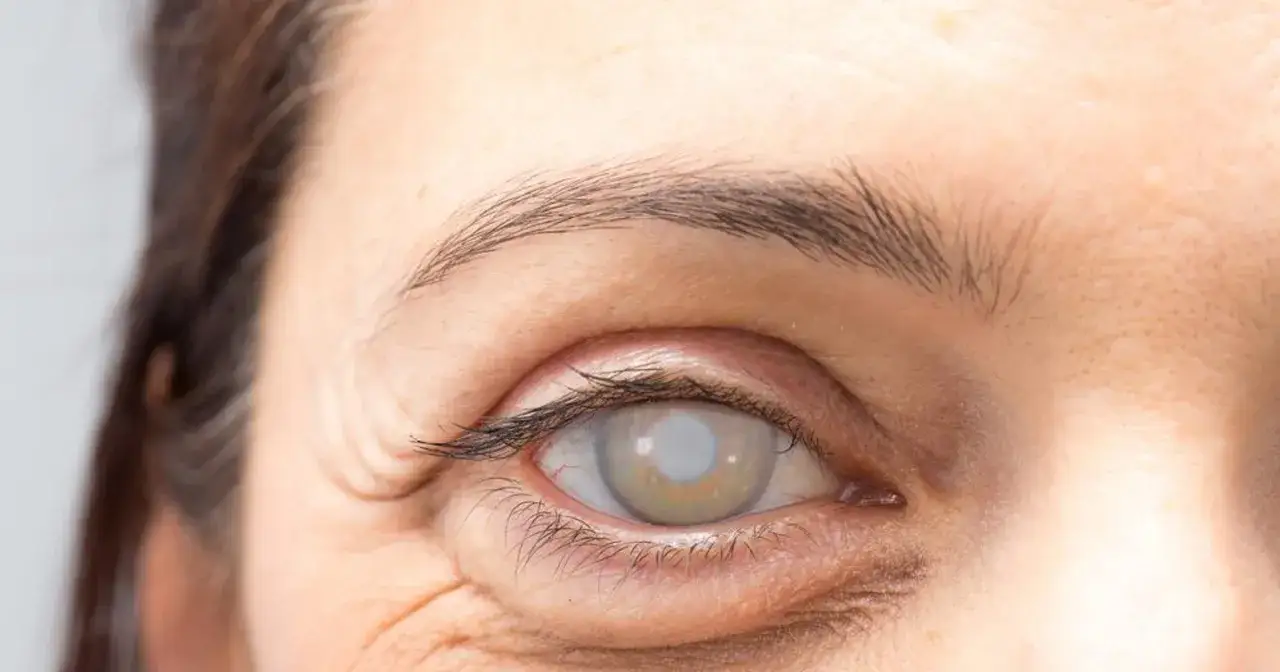 Jak zapobiegać zaćmie? 5 filarów dla zdrowych oczu!