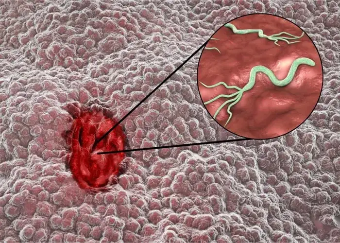 Pęknięcie wrzodu: rozpoznaj objawy zagrażające życiu