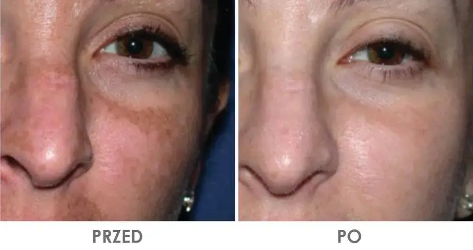 Gdzie kupić deep phyto peeling? Sprawdź najlepsze miejsca w Polsce