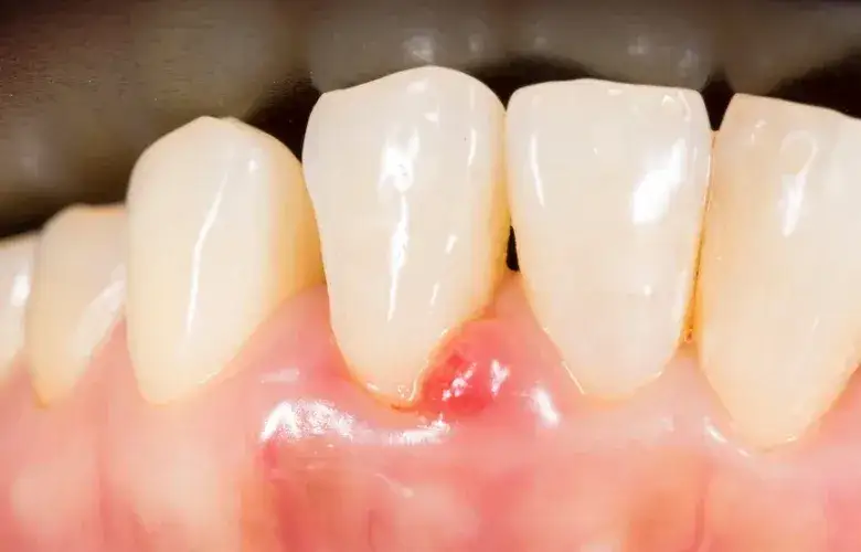 Jak wyleczyć zapalenie dziąseł i uniknąć bólu oraz powikłań