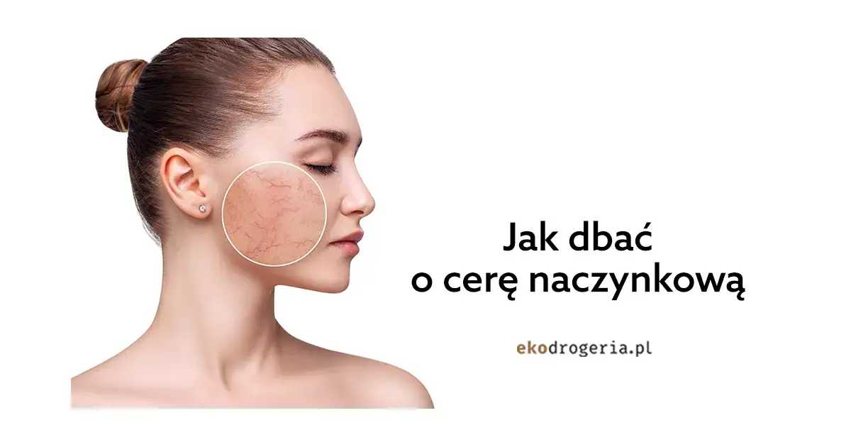 Jak dbać o cerę naczynkową? Skuteczne metody i porady eksperta