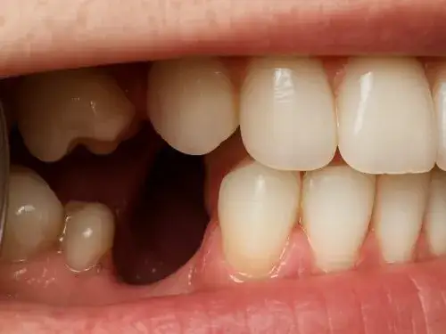 Rak zęba objawy: Poznaj prawdziwe symptomy nowotworów jamy ustnej