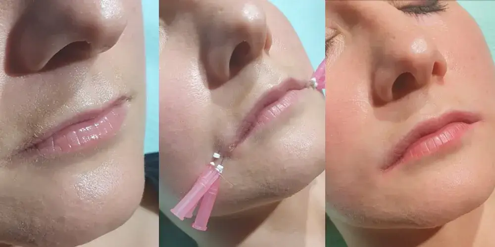 Powiększanie ust: Kiedy efekt? Ostateczny wygląd po 2-4 tyg.