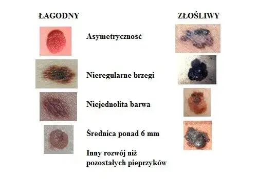Kto bada pieprzyki? Dermatolog wyjaśnia, kiedy to konieczne i na co uważać