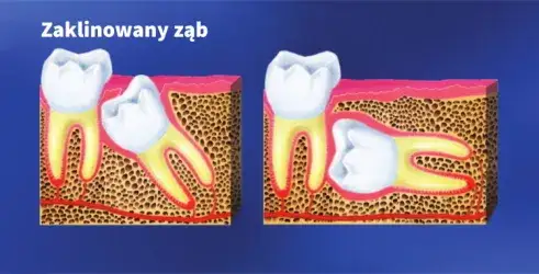 Objawy zęba mądrości: jak rozpoznać ból, stany zapalne i kiedy iść do dentysty