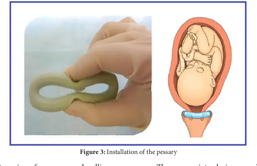 Kiedy poród po zdjęciu pessara? Wszystko, co musisz wiedzieć o pessarze i terminie porodu