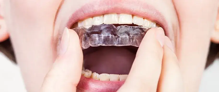 Bruksizm do jakiego lekarza? Dowiedz się, jak uniknąć bólu zębów