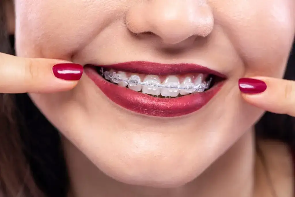 Aparaty ortodontyczne po 50: zaskakujące korzyści, które musisz poznać