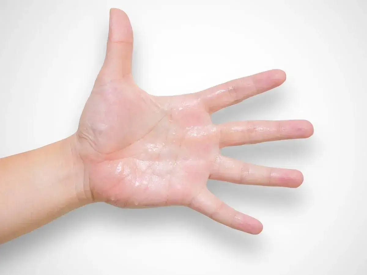 Jak zapobiec poceniu się dłoni – skuteczne metody i przyczyny problemu