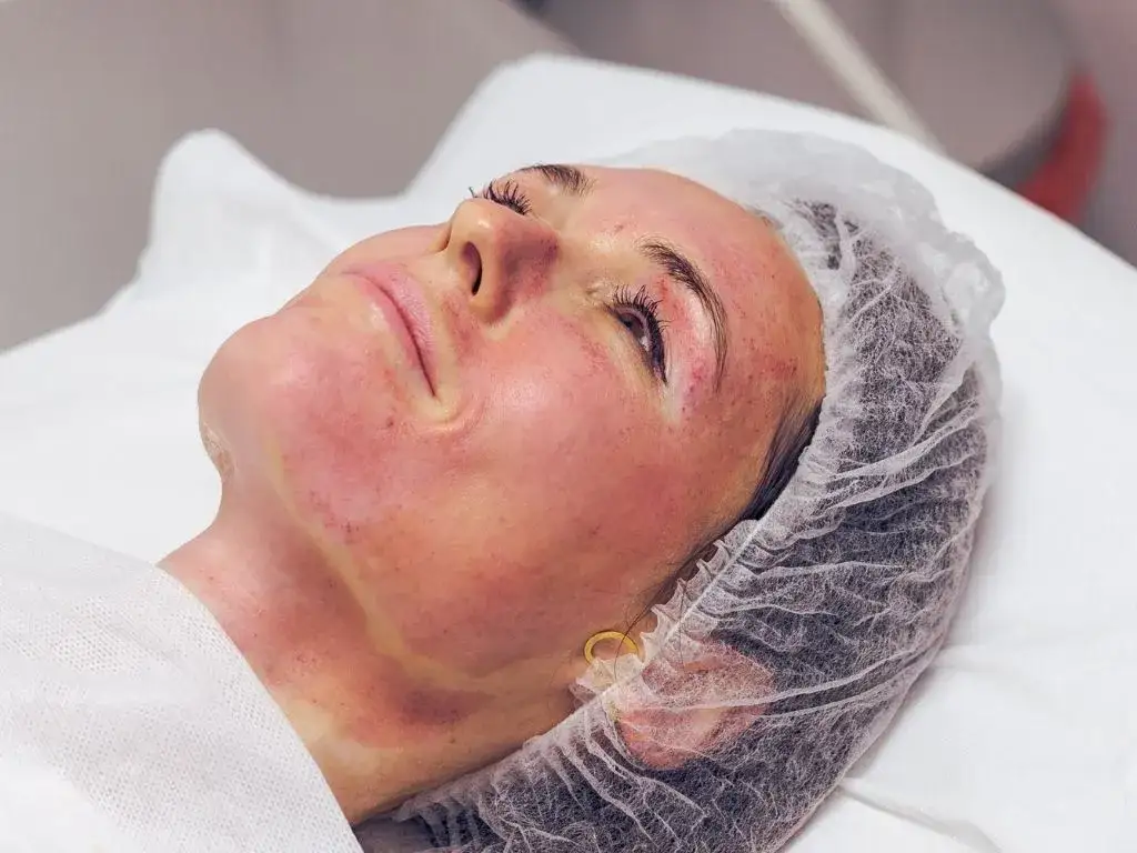 Czy można pić alkohol po dermapenie? Sprawdź skutki i zalecenia eksperta