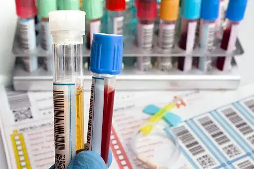 Cholesterol czy na czczo? Co musisz wiedzieć przed badaniem krwi