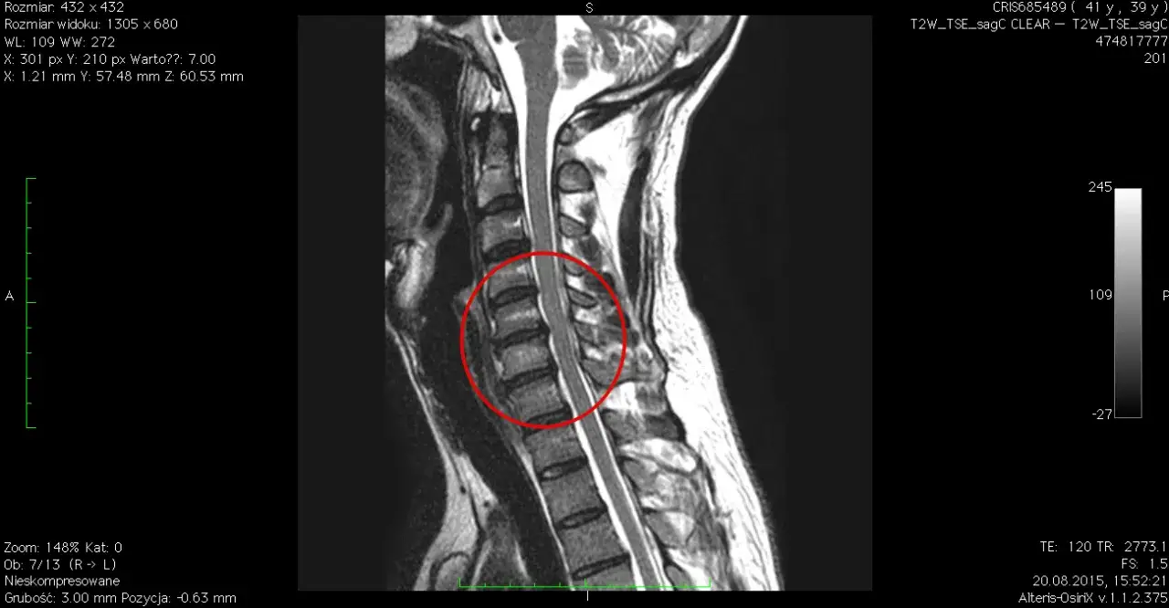 Choroba krążka międzykręgowego szyjnego: objawy i leczenie