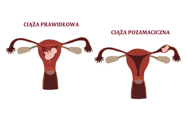 Ciąża pozamaciczna a test ciążowy - co musisz wiedzieć?