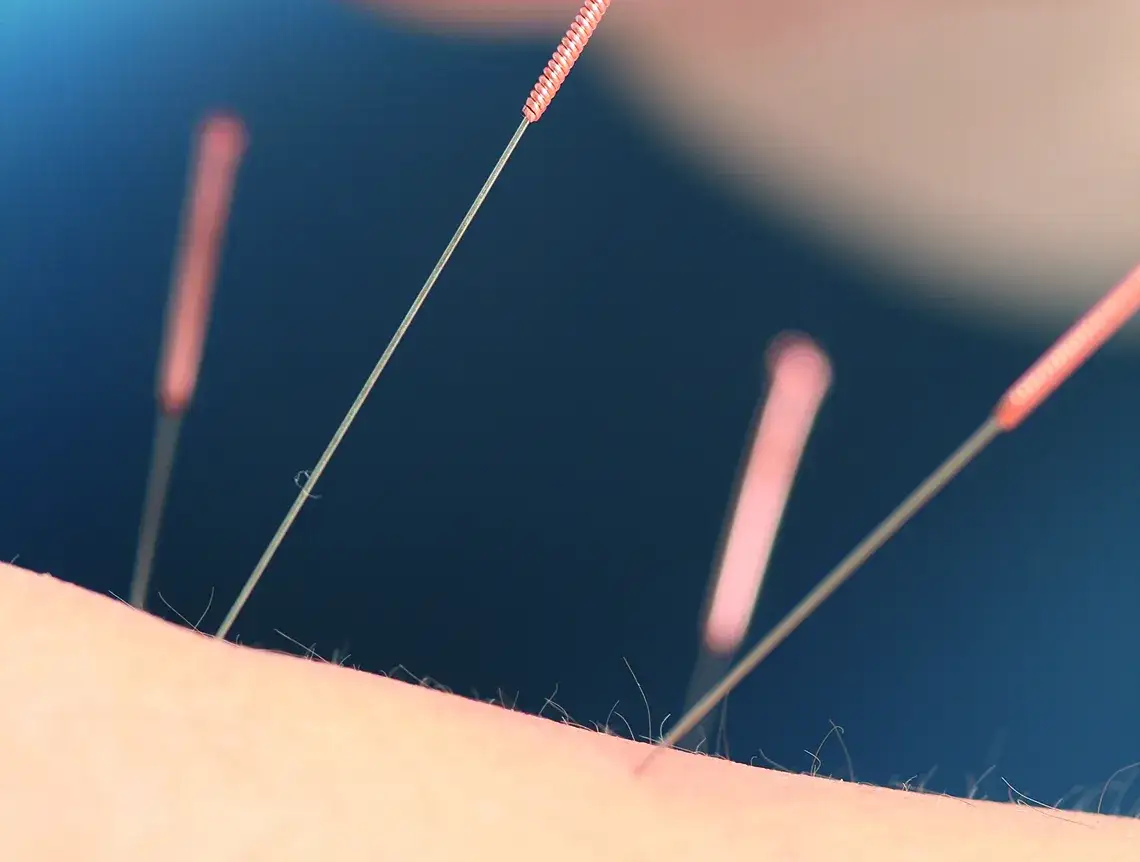 Akupunktura na kręgosłup szyjny: Jak złagodzić ból i napięcie?