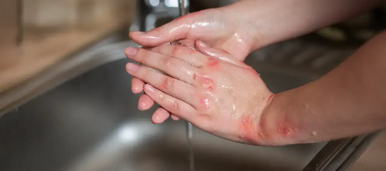 Pękająca skóra dłoni z ranami, które są myte pod bieżącą wodą.