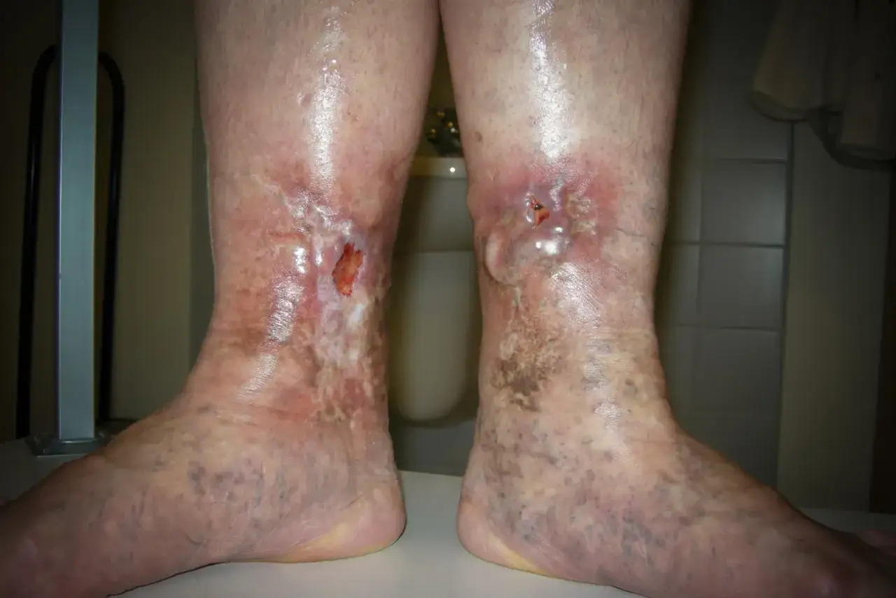 Leki na zakrzepicę żył: Co działa, a co jest mitem?