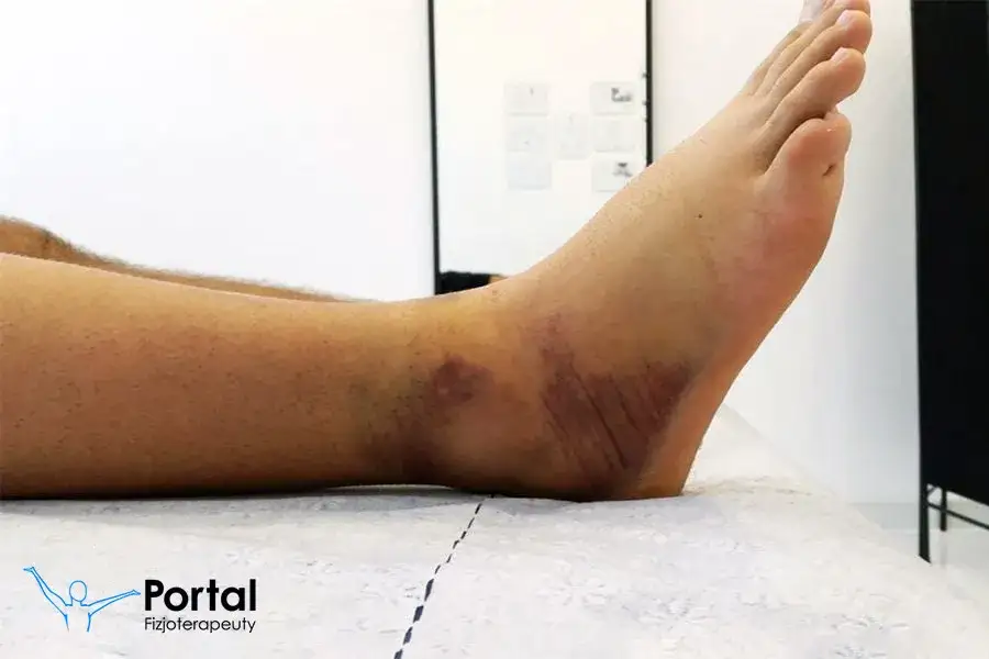 Skręcenie stawu skokowego: Ile trwa przerwa i jak szybko wrócić do formy?