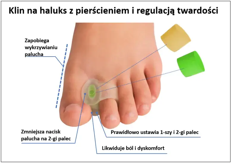 Haluks: Ból stóp? Jak rozpoznać i skutecznie leczyć paluch koślawy