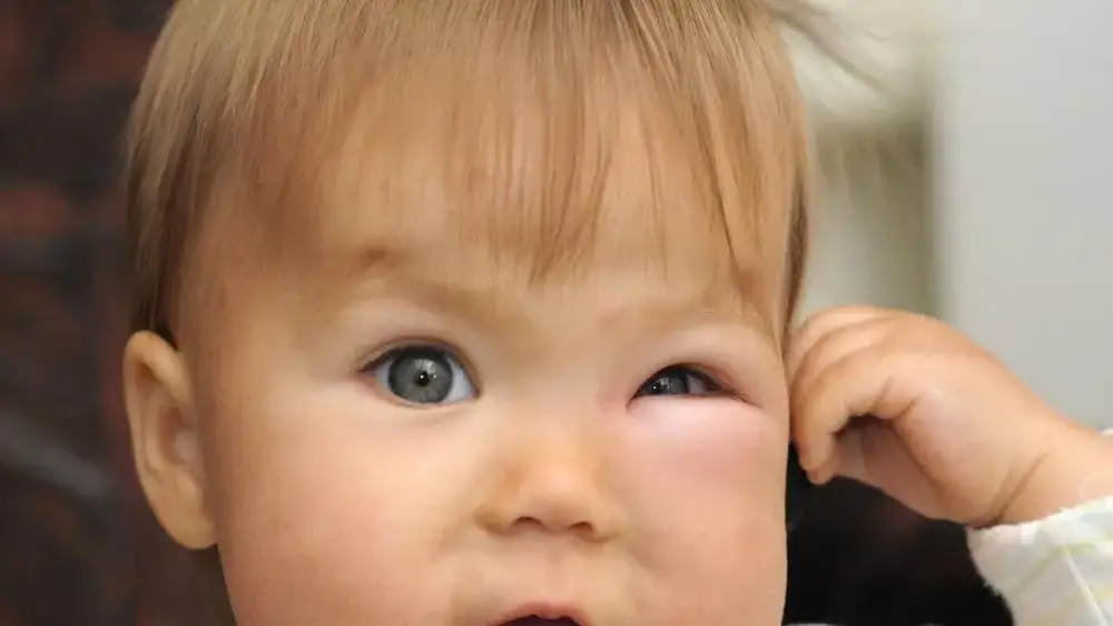 Spuchnięte oko u dziecka – co robić, aby złagodzić objawy?