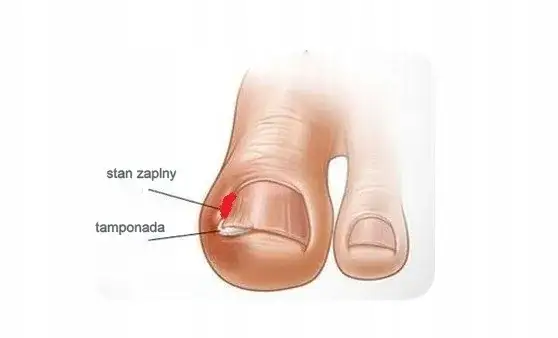Tamponada paznokcia: skuteczna metoda na wrastające paznokcie