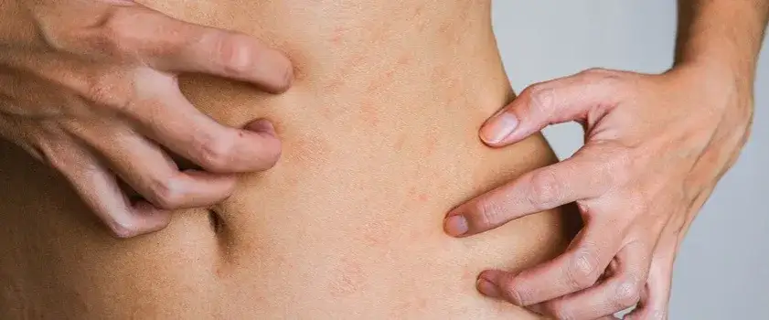 Alergia na kurz: objawy skórne, jak rozpoznać i leczyć