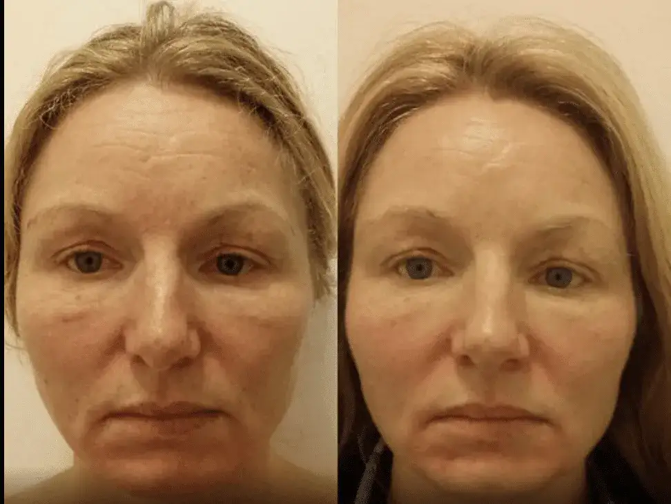 Masaż Kobido: Jak często? Intensywna seria i podtrzymanie efektów