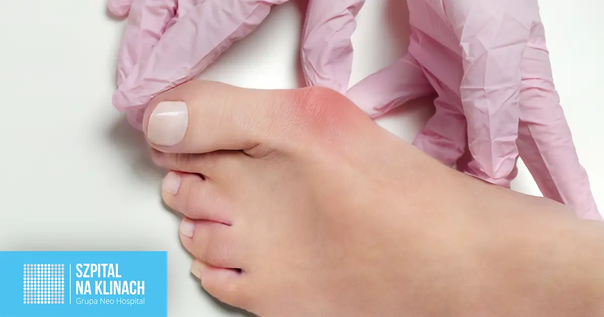 Haluksy: Jaki lekarz i jak leczyć? Od diagnozy po operację