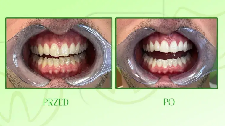 Wybielanie zębów u dentysty: Czy warto? Cena, metody, efekty