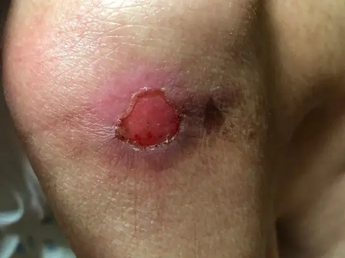 Odleżyny u osób starszych: Jak skutecznie leczyć i zapobiegać?