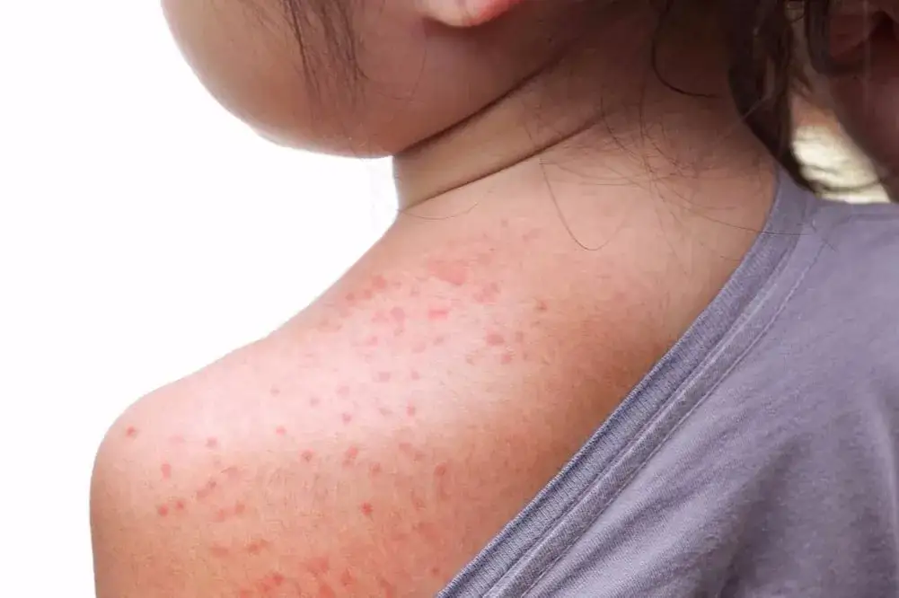 Alergia na psa u dziecka: Objawy, rozpoznanie i co robić?