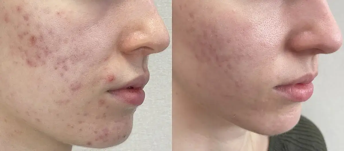 Jak wygląda zapchana cera? Objawy i skuteczne metody leczenia