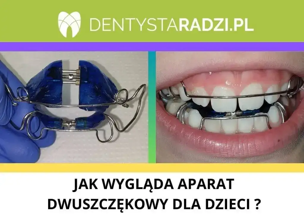 Aparat ortodontyczny z NFZ: Tylko dla dzieci? Prawda o refundacji