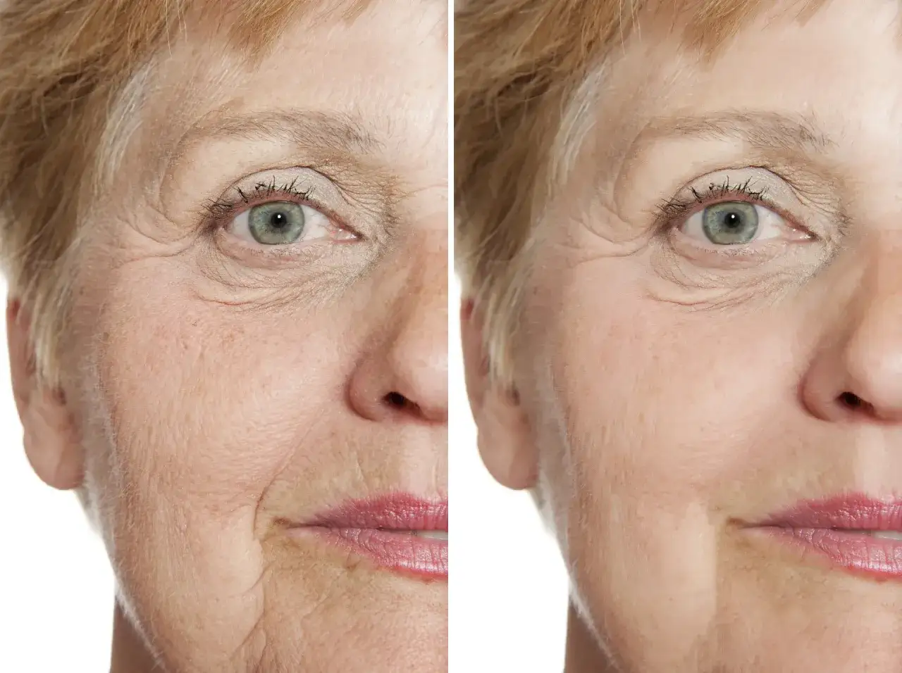Porównanie twarzy: po lewej widoczne zmarszczki, po prawej skóra wygładzona. Co niszczy kwas hialuronowy?