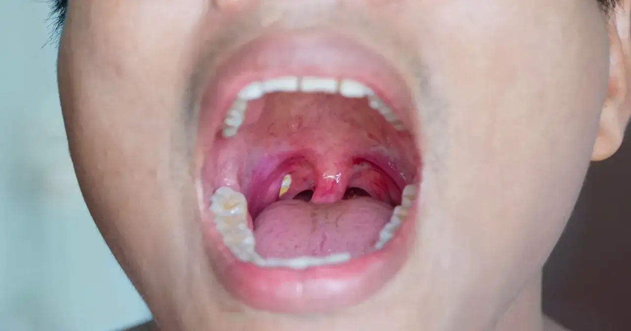 Widoczne zapalenie migdałków z białą kropką w buzi. Czerwone gardło i widoczne zęby.