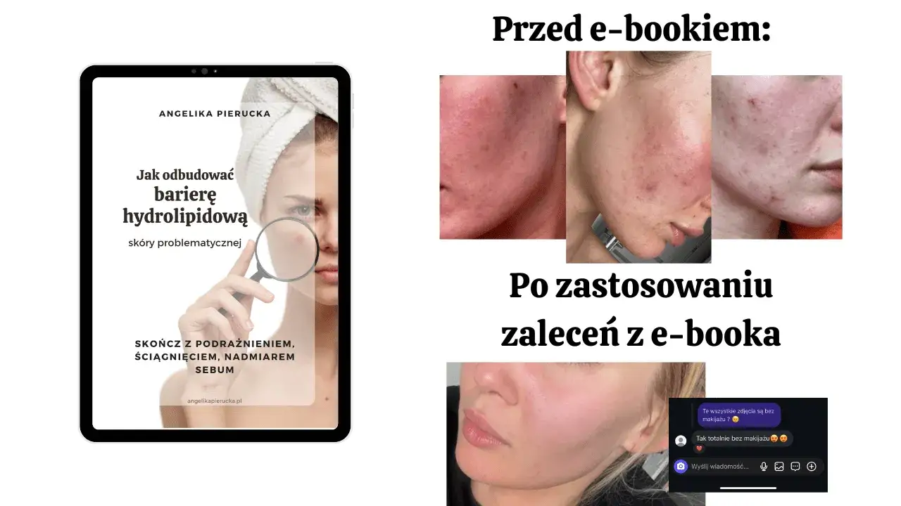 Skuteczne sposoby na czerwone plamy po pryszczach i ich redukcję