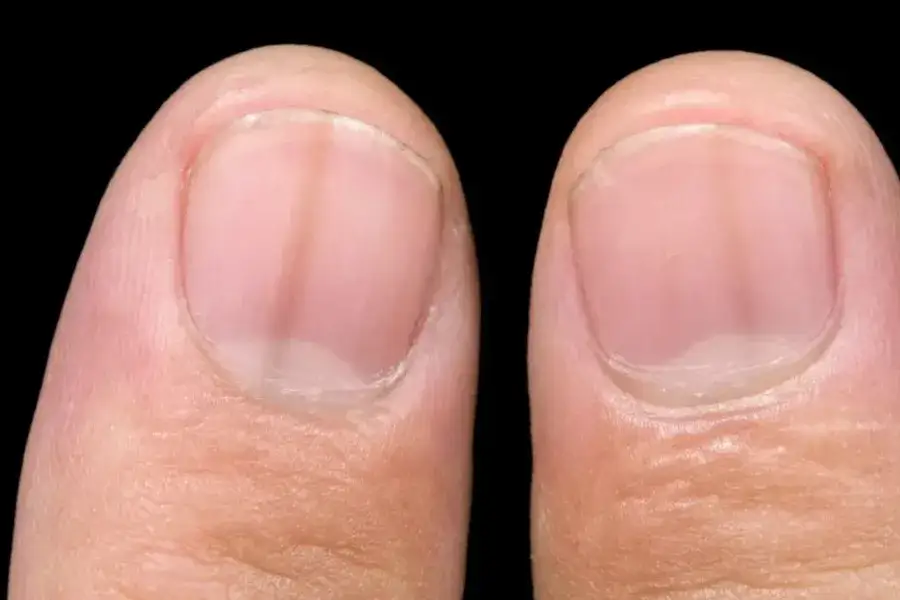 Czarna kreska na paznokciu – co to oznacza i kiedy się martwić?