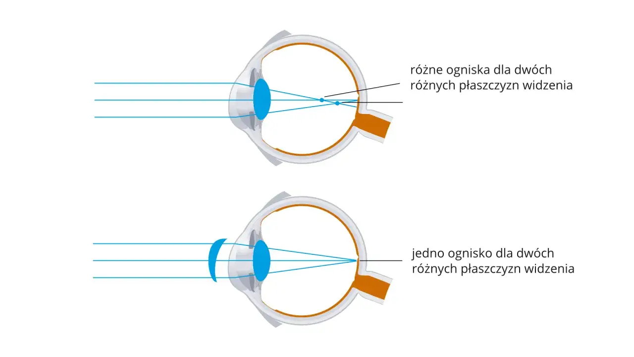 Korekcja krótkowzroczności: Jak działają soczewki rozpraszające?